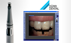 Using SIDEXIS DUERR CONNECT any SIDEXIS XG installation can talk to digital DUERR USB intraoral video cameras